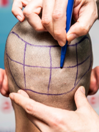 FUE-Haartransplantation